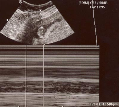 First Ultrasound - 12 weeks