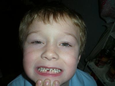 Who is one tooth less?