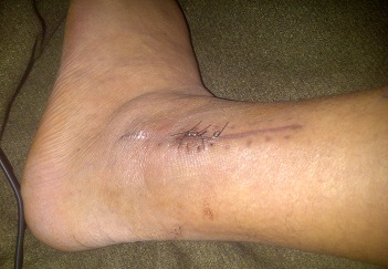 The outside of my left ankle.