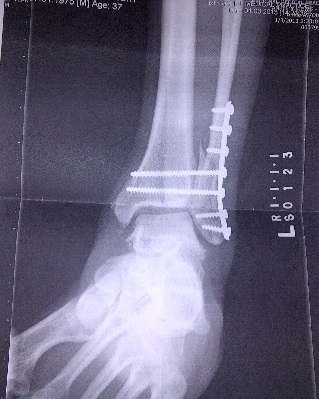 The original x-ray of my ankle after surgery.