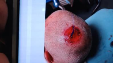 First pic of the head injury. Taken while boarding an ambulance.
